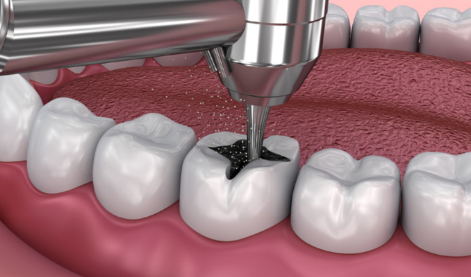 Routine teeth fillings prevent advanced dental issues by removing decay and restoring tooth structure