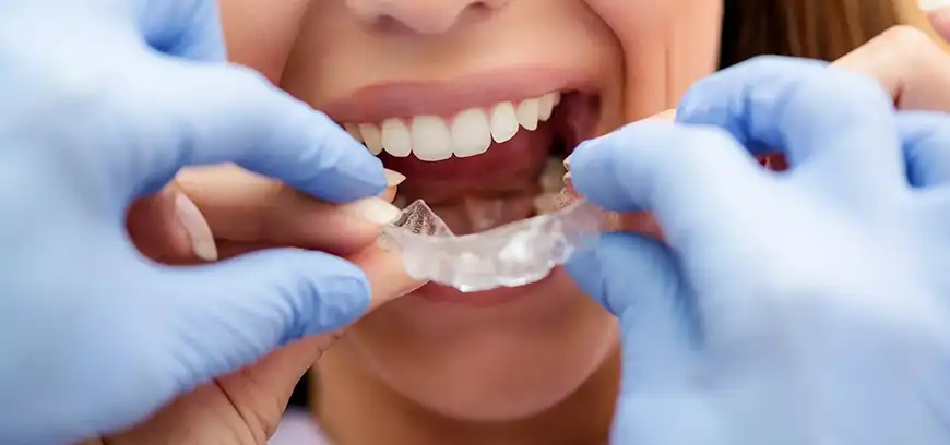 Orthodontic Treatment with Clear Invisible Aligners for Teeth Straightening in Peelamedu Clinic