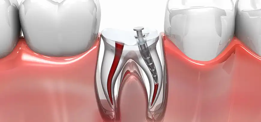 Get the best root canal treatment near Peelamedu, Coimbatore for painless and effective dental care