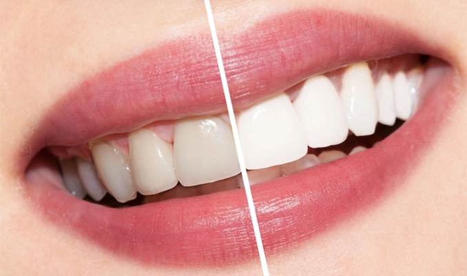 Dental veneers have several disadvantages & difficulties when selecting them for aesthetic improvement.