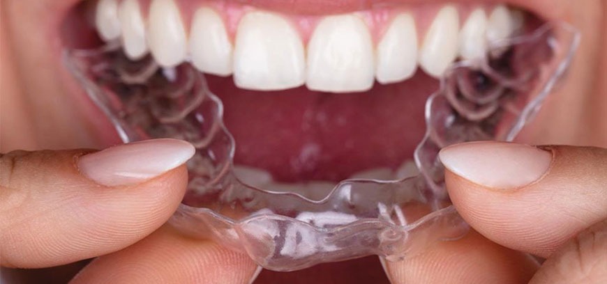 A woman is showing off her sparkling teeth while holding a transparent braces to correct her teeth.