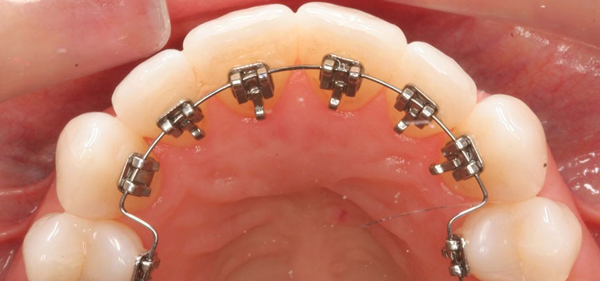 Teeth that have undergone orthodontic treatment to align them and are fitted with metal braces/Clip.