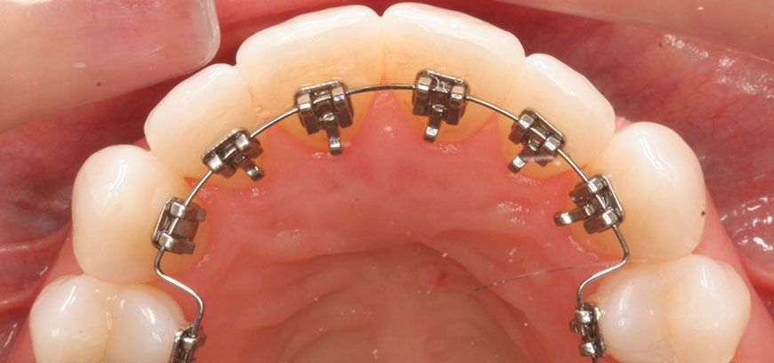 Orthodontics,Clip/Braces Treatment in HopeCollege,Coimbatore