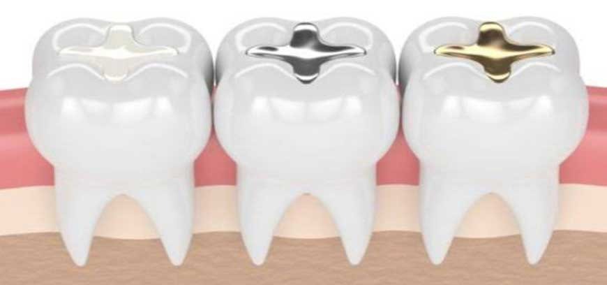 A close-up view of the prosthetic teeth and gums in a patient's mouth with dental implants .