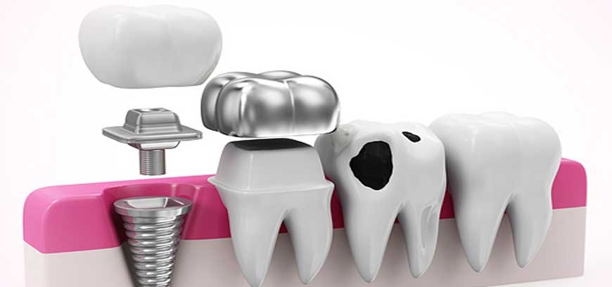 Dental implant adjacent to a tooth in a pink case, necessary for dental impant treatments.