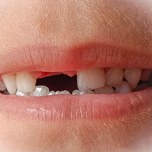Age-related dental problems contributing to loss of multiple teeth