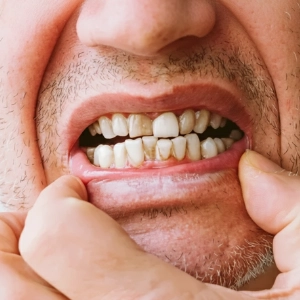 Fast-spreading gum disease in younger patients is treated early to control rapid bone loss.