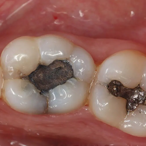 Highlights how large older fillings can weaken the tooth structure, leading to potential cracks.