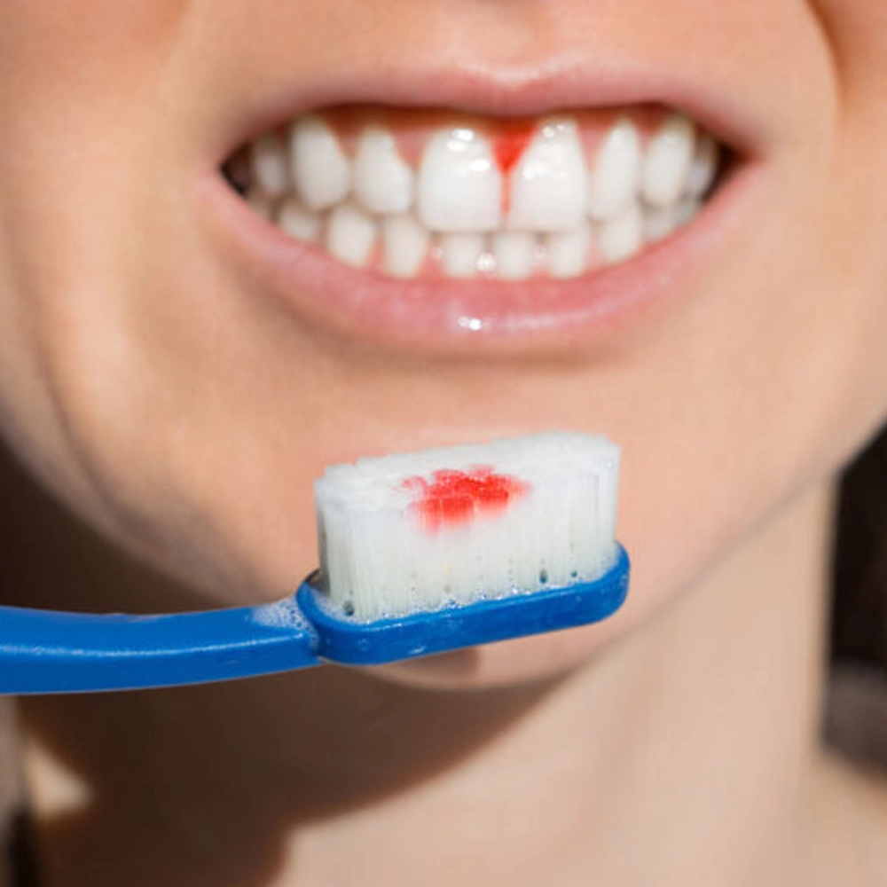 Bleeding, swollen gums and bad breath? Know early gum disease symptoms before it worsens.