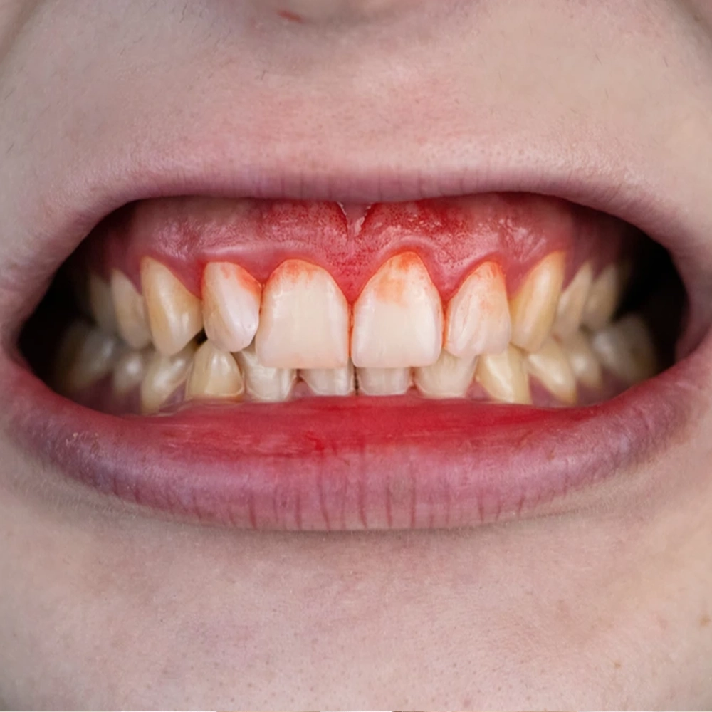 Effective treatment for bleeding gums in Coimbatore to reduce inflammation and promote healthy gums.