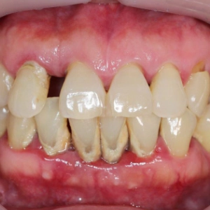 Long-term gum infection damaging bone and tissue is managed with timely periodontal treatment.