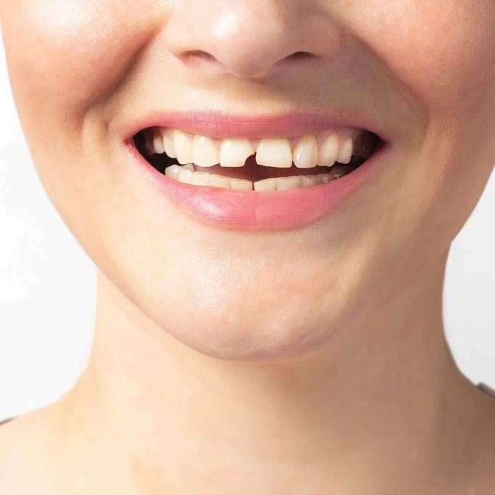 Identify biting pain and temperature sensitivity as signs of a tooth crack.