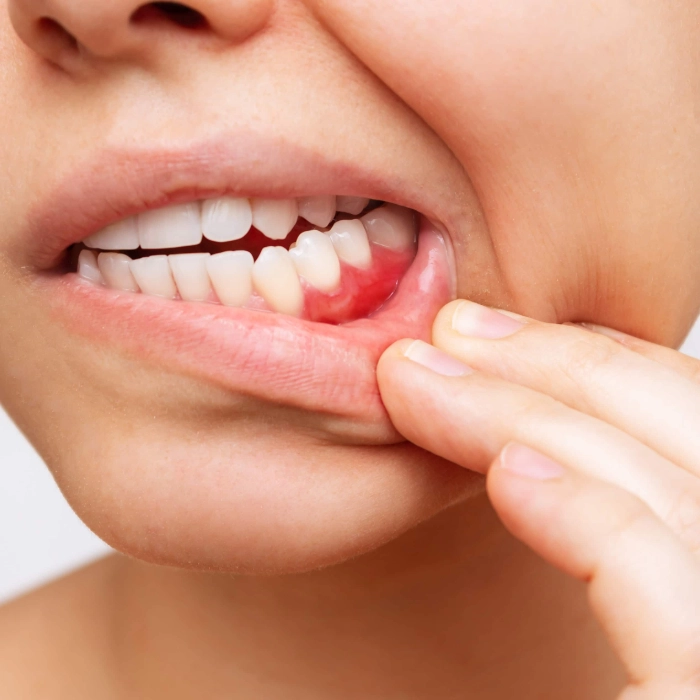 Bleeding, swollen gums, and bad breath are early signs of gum disease needing dental care.
