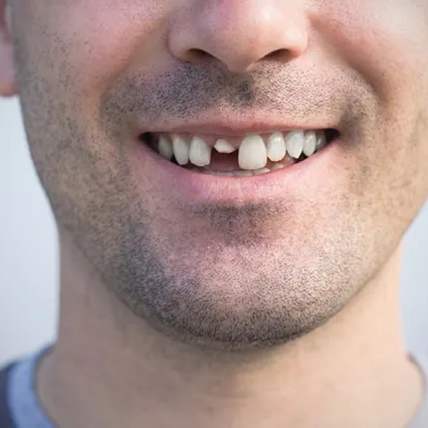 Visual representation of a tooth with structural damage like cracks or chips requiring repair