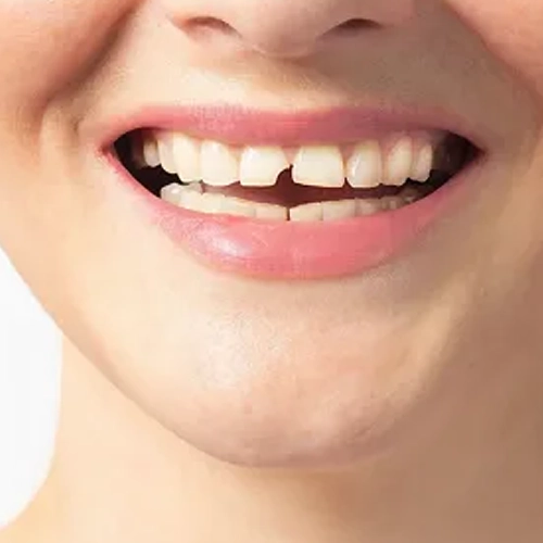 Cracked or broken teeth expose the nerve and cause sudden pain while chewing.