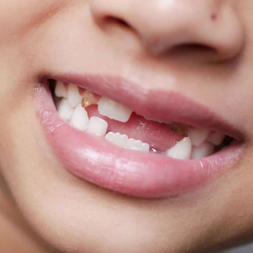 Effective treatment for cracked teeth in Coimbatore to restore strength and prevent pain.