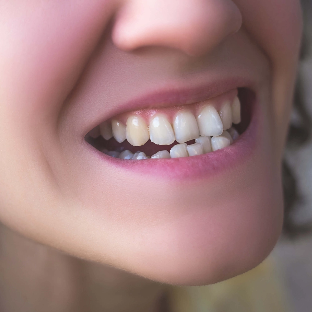 Correct crooked teeth in Coimbatore with effective dental treatments for a straight smile.