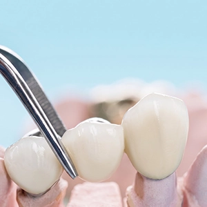 Dental bridge replacing one or more missing teeth
