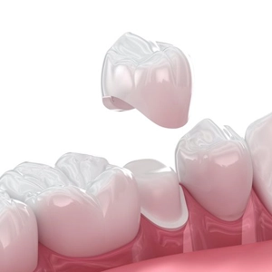 Durable porcelain crowns to strengthen and protect severely cracked teeth.