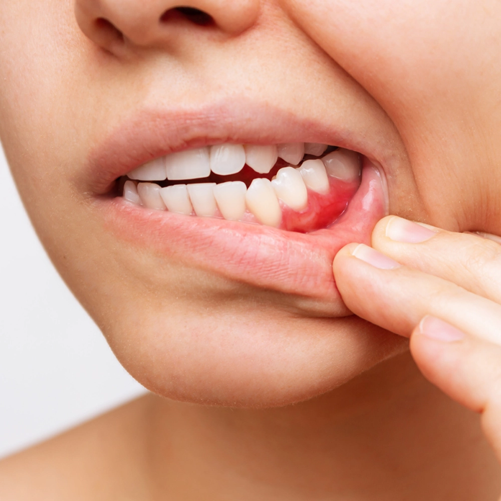 Effective dental infection treatment in Coimbatore to relieve pain and protect teeth.