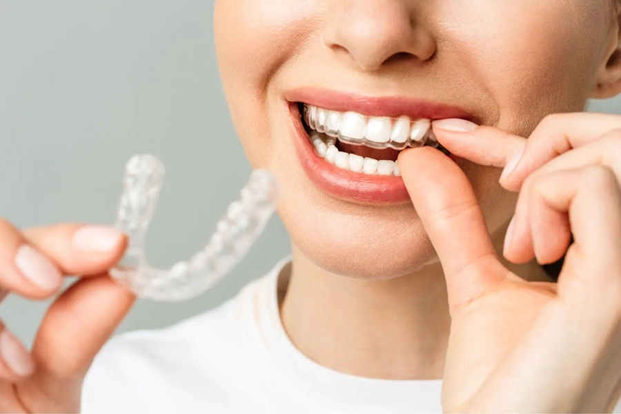 Custom dental mouth guards to prevent injuries from sports and teeth grinding.