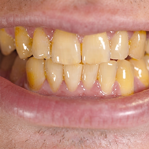 Enamel wears away over time, making teeth appear more yellow with age.