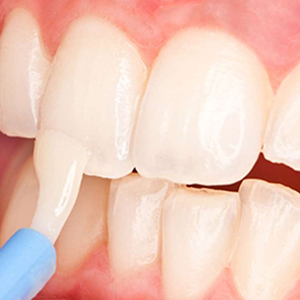 Fluoride treatment protects tooth roots, strengthens enamel, and lowers nerve sensitivity long term.
