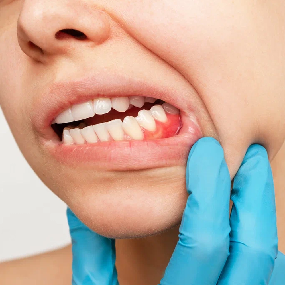 Trusted periodontist in Coimbatore for bleeding gums and early gum disease care.