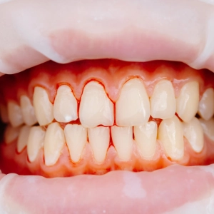 We treat early gum redness and bleeding to reverse gingivitis and restore healthy gum tissue.