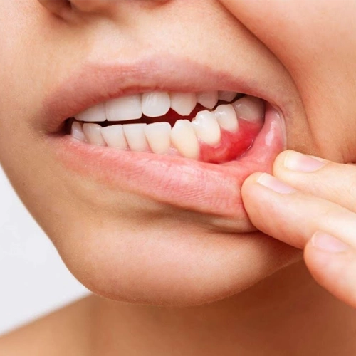 Plaque Buildup Near the Gum Line