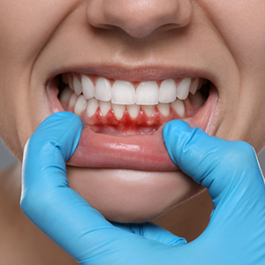 Treat gum infections and inflammation that cause bad breath. Professional gum care improves oral health and breath freshness