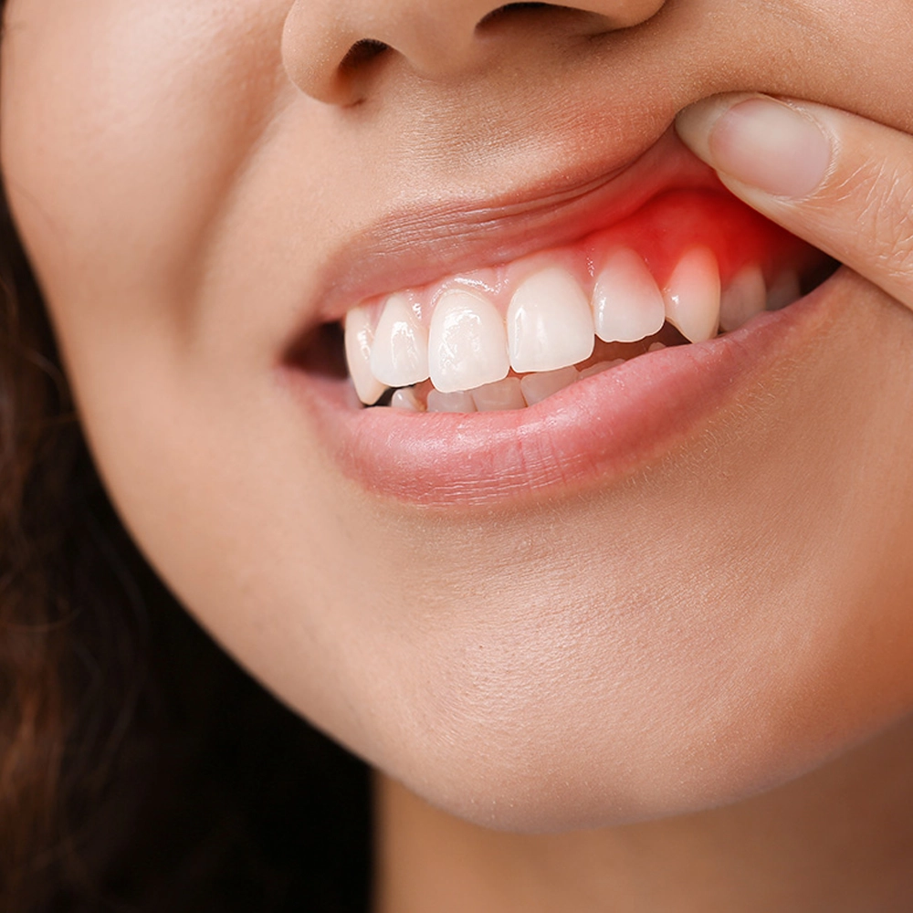 Professional gum care treatment in Coimbatore to reduce infection and improve gum health.