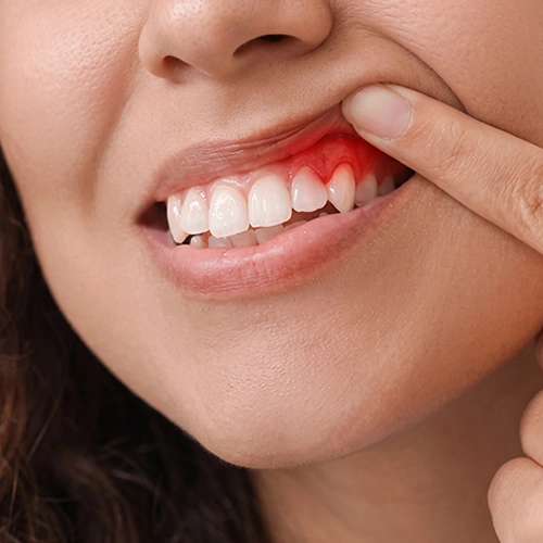 Gum disease destroying tissue around teeth causing tooth loss