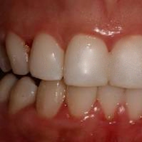 Gum disease occurs when inflamed gums damage tissues and create ongoing discomfort.