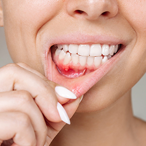 Poor Oral Hygiene and Bacterial Growth