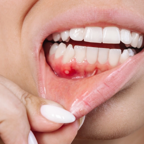 Diabetes and Hormonal Gum Problems