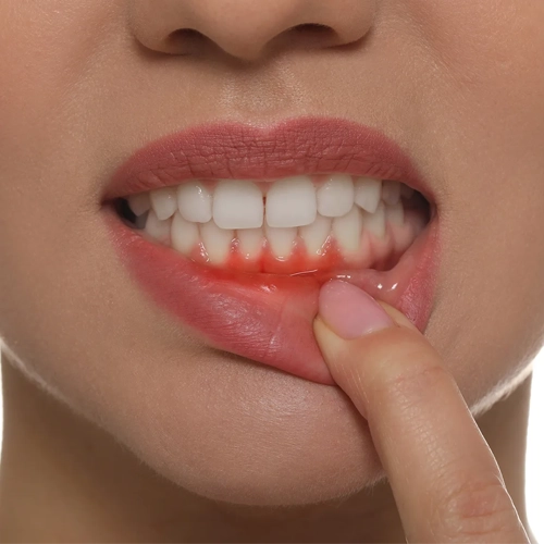 Poor Oral Hygiene and Bacterial Growth