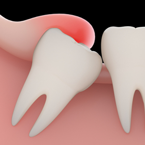Gum tissue over wisdom teeth becomes inflamed and tender, causing pain when touched.