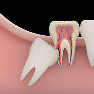 Impacted wisdom teeth grow sideways, building pressure and triggering severe jaw pain.