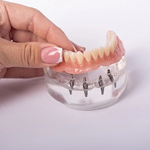 Implant-supported denture providing added stability