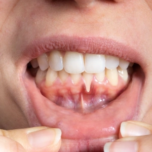 Gum disease related to diabetes or immune conditions is treated to support overall health.