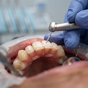 Removes superficial enamel stains that don't respond to regular cleaning.