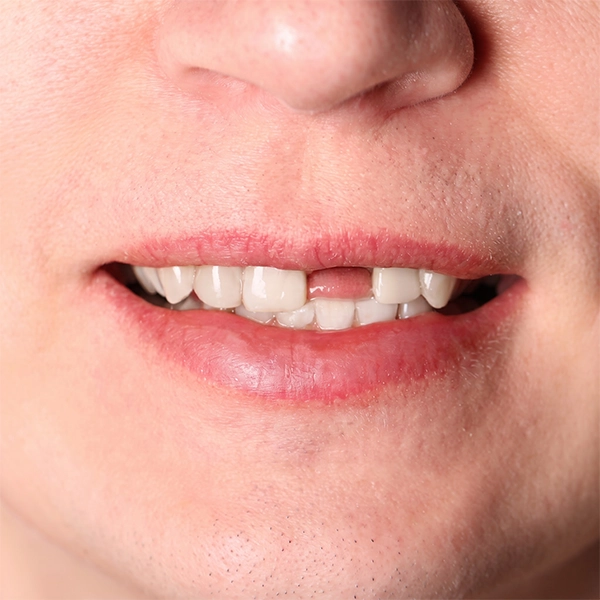 Expert evaluation and treatment for yellow and discoloured teeth at Sri Sakthi Dental Clinic.