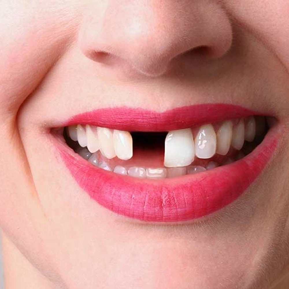 Replace missing teeth in Coimbatore with effective dental solutions for a complete smile.