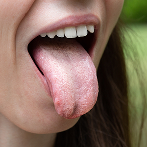Plaque Buildup Near the Gum Line