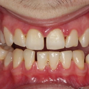 Severe gum infections with tissue damage are treated promptly to prevent further complications.