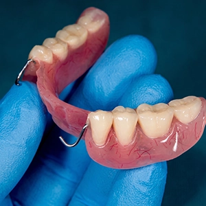 Partial denture replacing several missing teeth