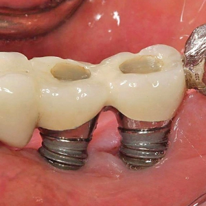 Infections around dental implants are managed carefully to maintain implant stability and life.