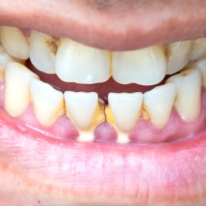 Plaque near the gum line leads to irritation, swelling, and gum infection if left untreated.