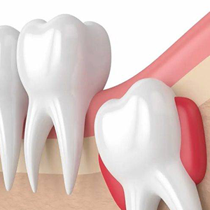 Small cysts or infections near wisdom teeth increase pain and make chewing difficult.